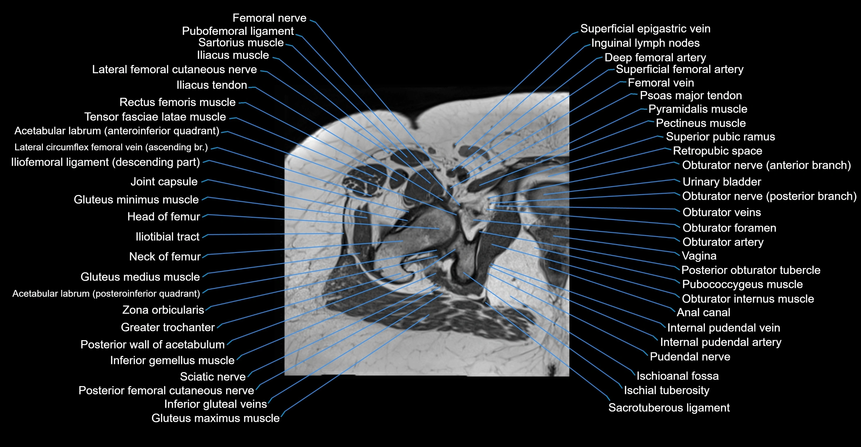 MRI hip axial cross sectional anatomy 3T 3D  radiology  anatomy image-img-00001-00046.webp